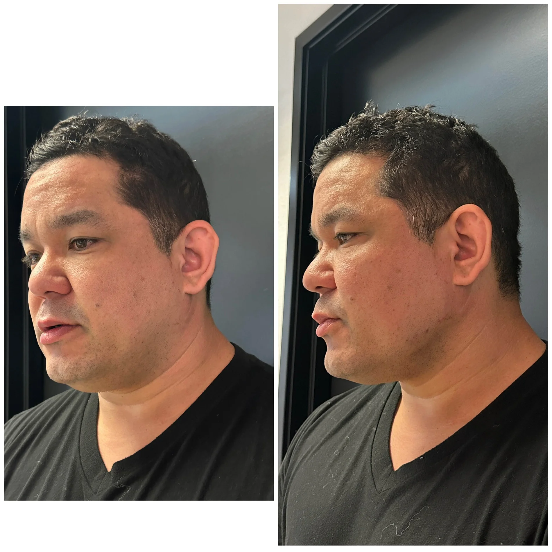 Dailyglowspa_Before_and_After_Image_Male_Midface_and_Jawline_Fillers_One_in_San_Diego_CA
