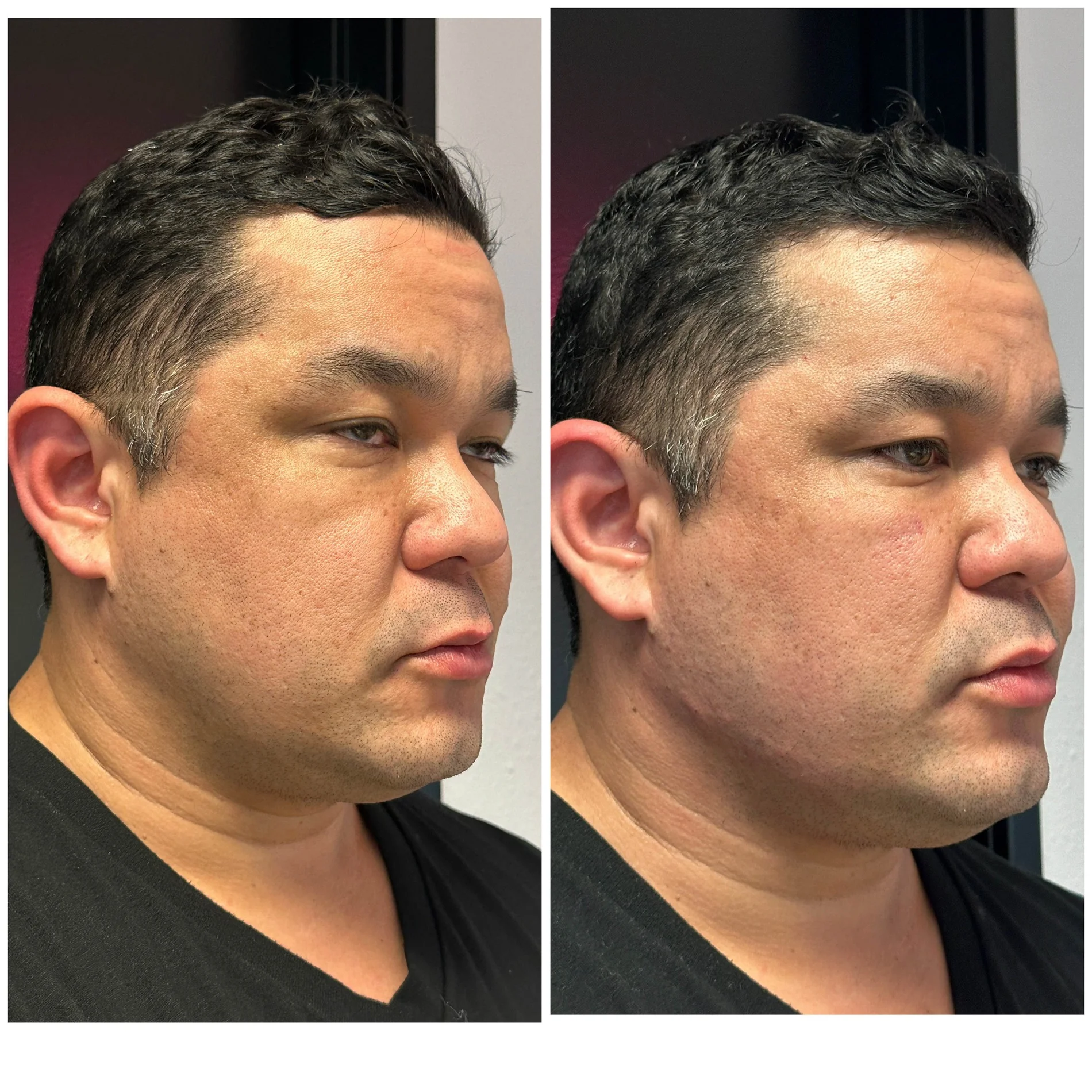 Dailyglowspa_Before_and_After_Image_Male_Midface_and_Jawline_Fillers_Three_in_San_Diego_CA
