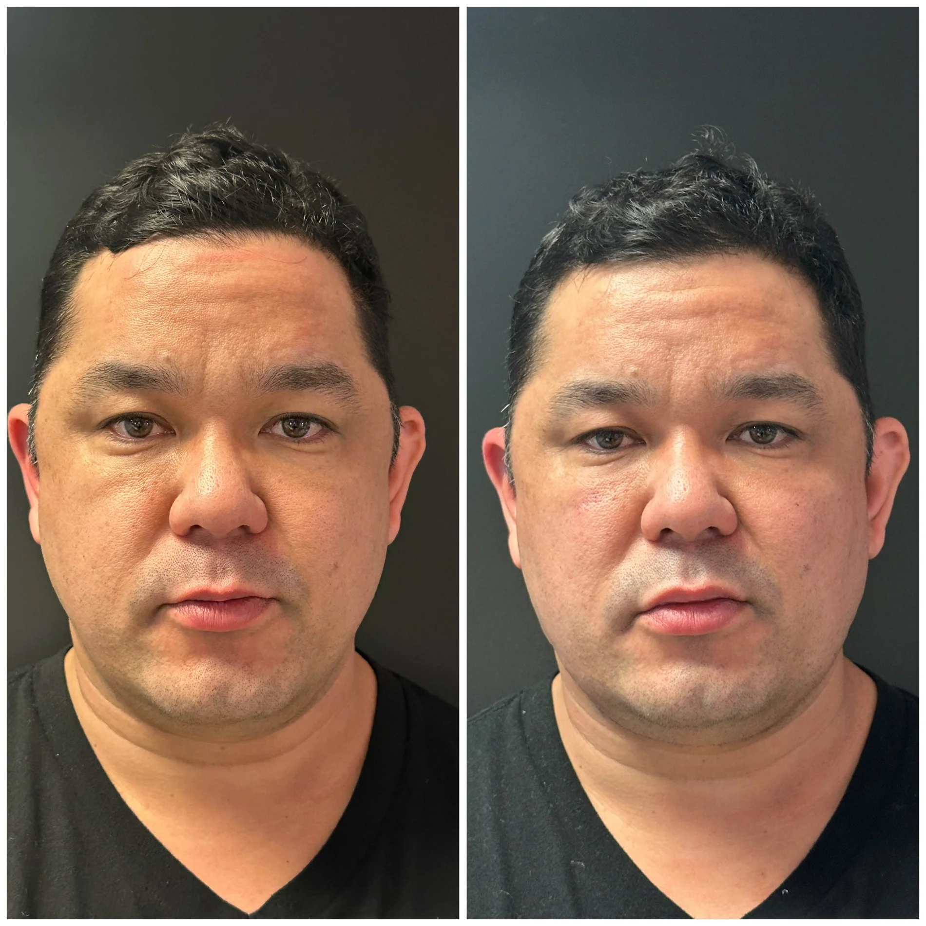 Dailyglowspa_Before_and_After_Image_Male_Midface_and_Jawline_Fillers_Two_in_San_Diego_CA