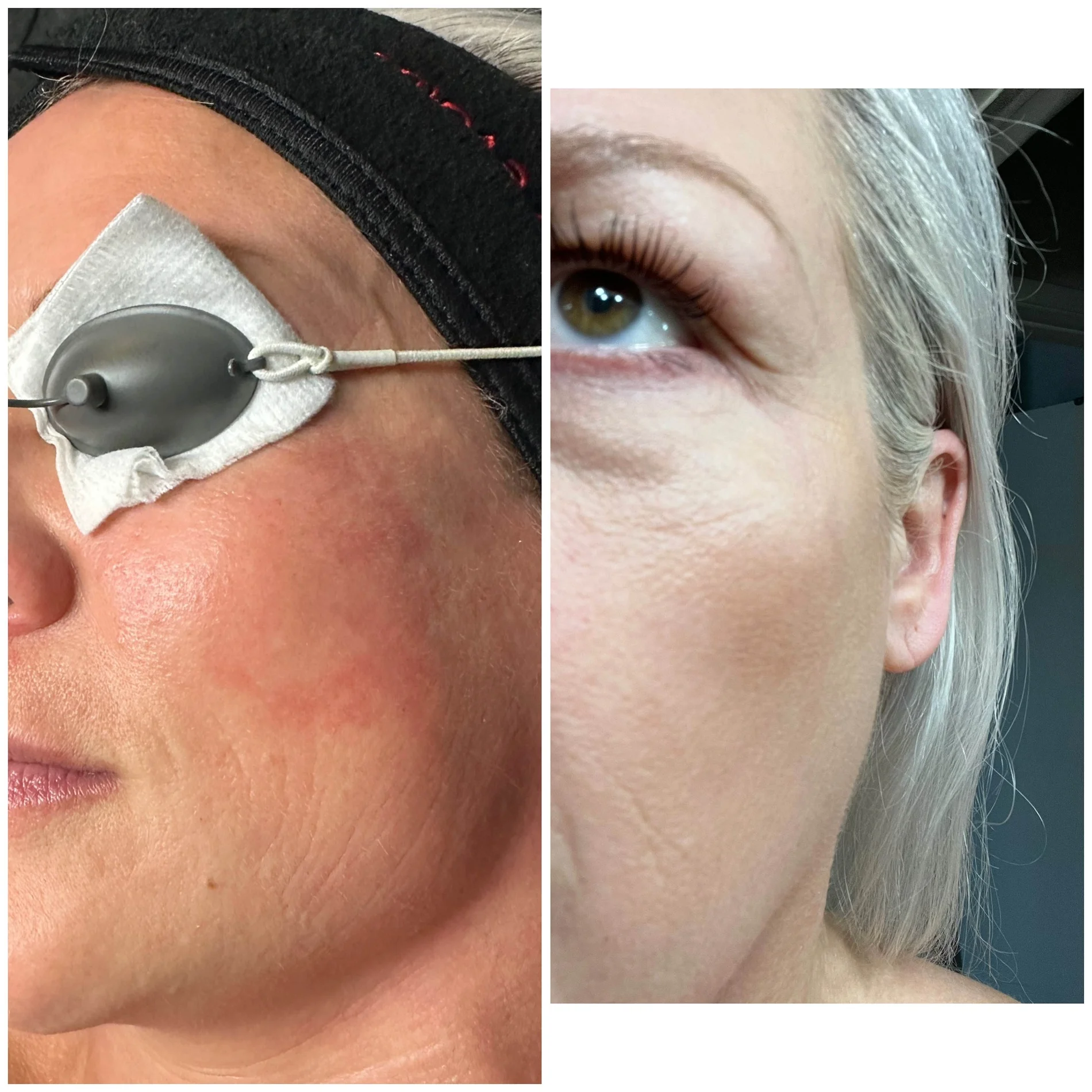 Dailyglowspa_Before_and_After_Image_Rosacea_One_in_San_Diego_CA