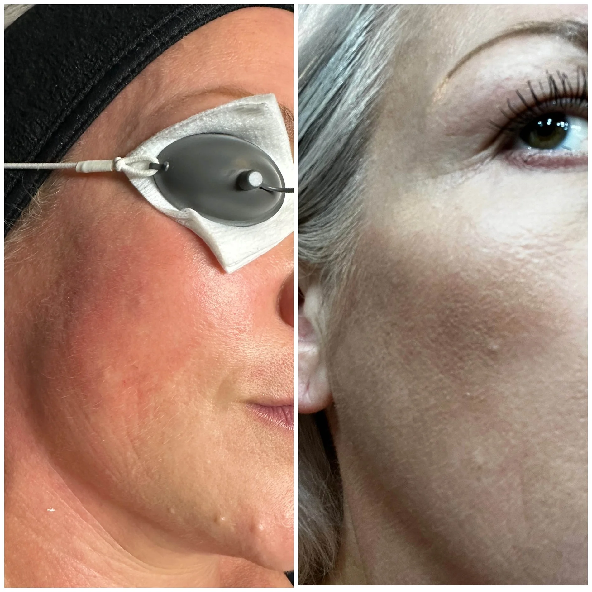 Dailyglowspa_Before_and_After_Image_Rosacea_Two_in_San_Diego_CA