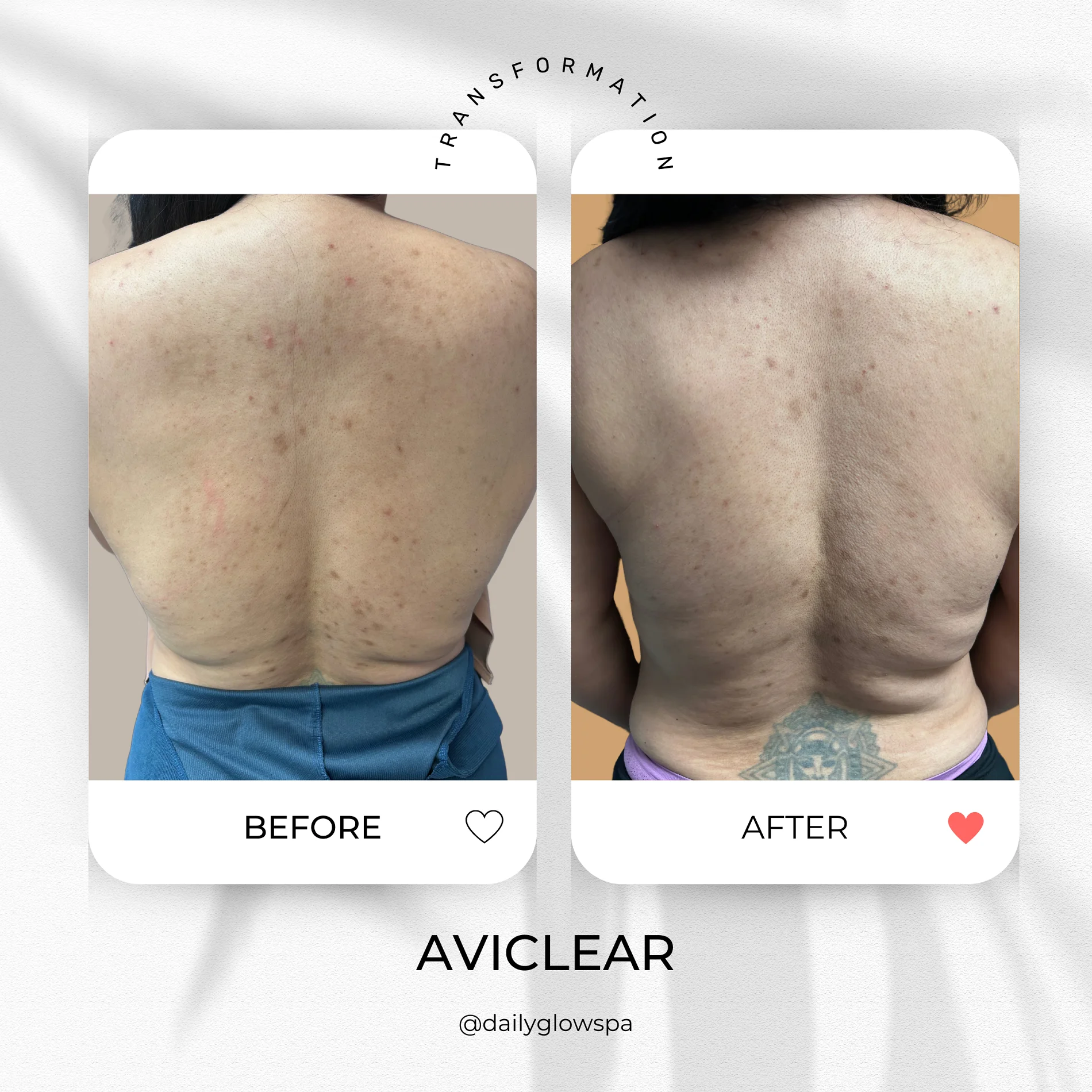 Dailyglowspa_Before_and_After_Aviclear_Four_in_San_Diego_CA