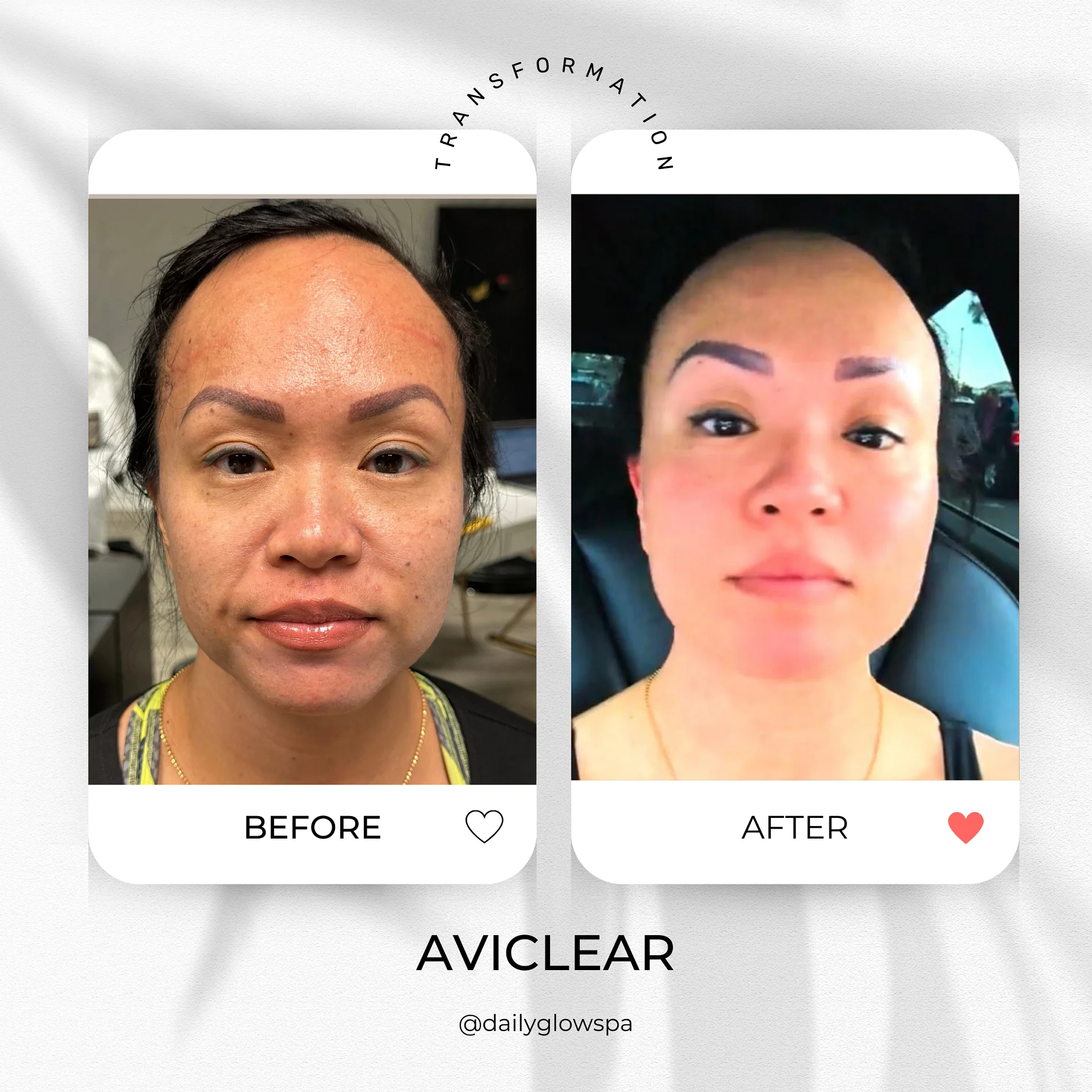 Dailyglowspa_Before_and_After_Aviclear_One_in_San_Diego_CA