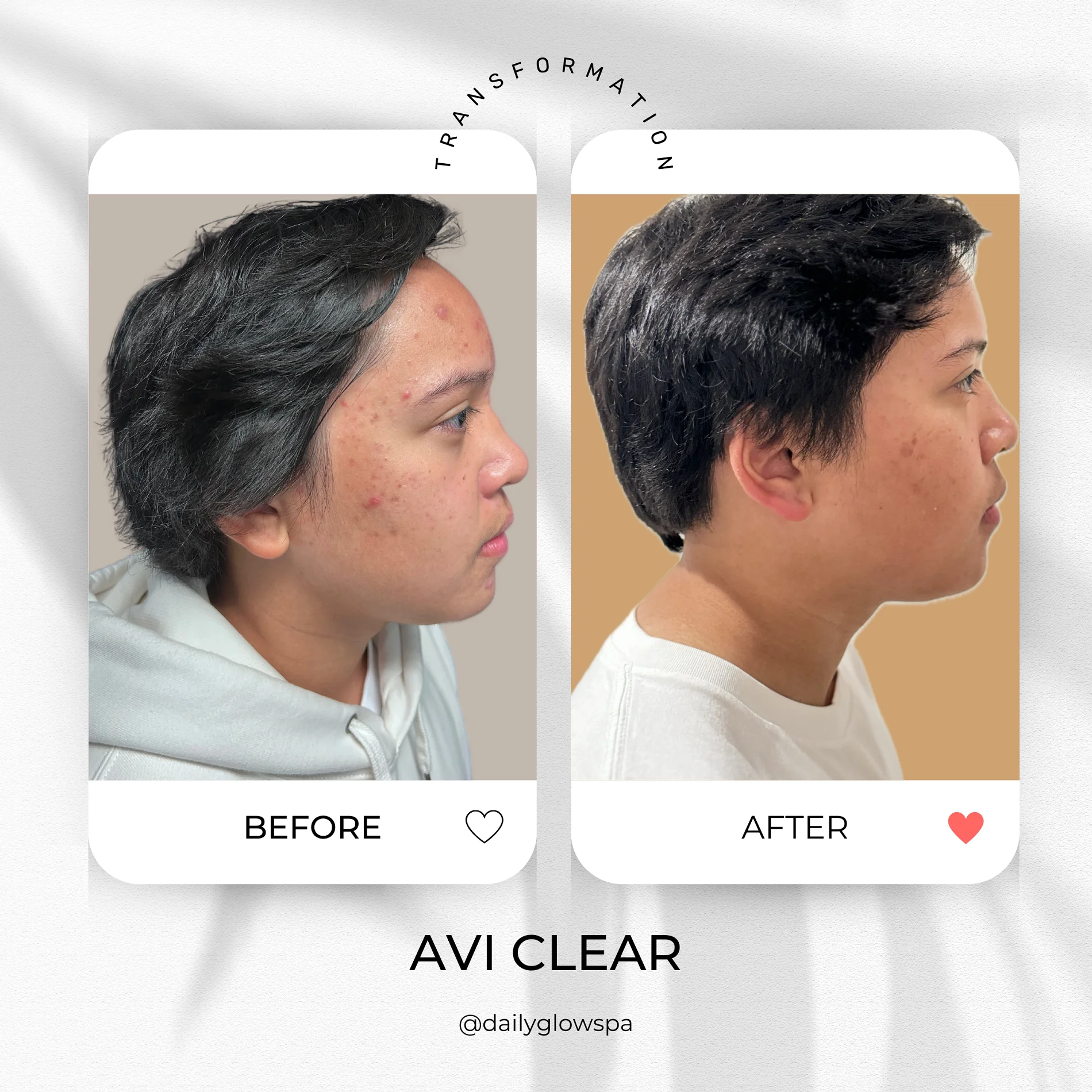 Dailyglowspa_Before_and_After_Aviclear_Three_in_San_Diego_CA
