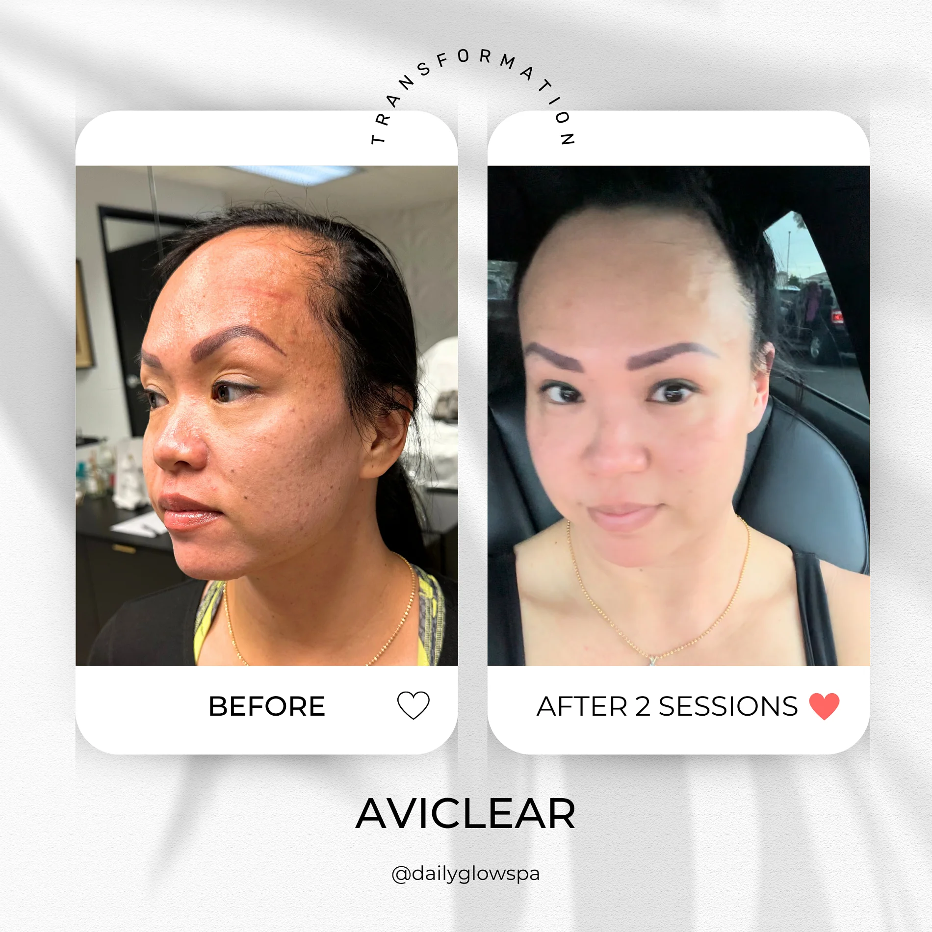 Dailyglowspa_Before_and_After_Aviclear_Two_in_San_Diego_CA