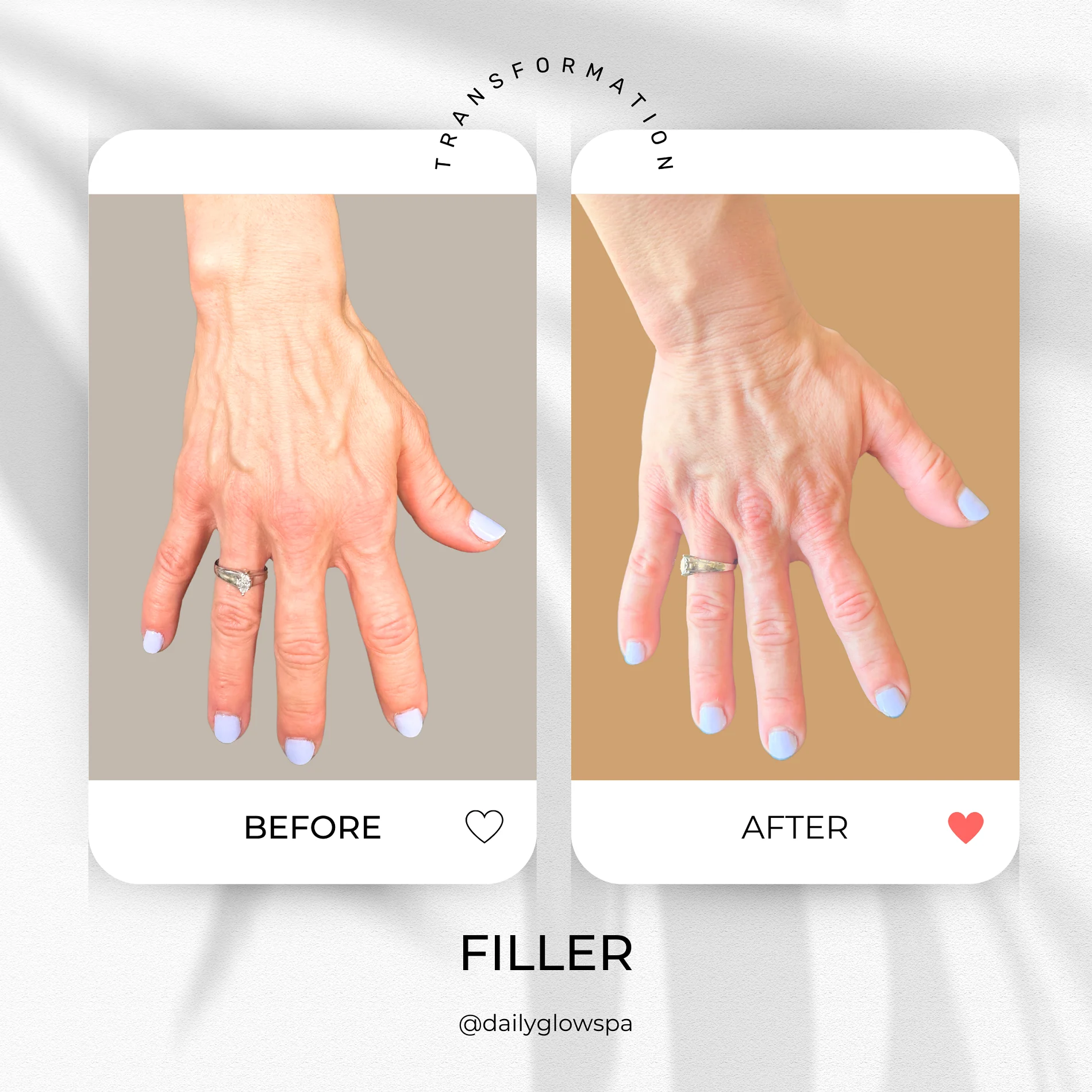 Dailyglowspa_Before_and_After_Dermal_Fillers_Six_in_San_Diego_CA