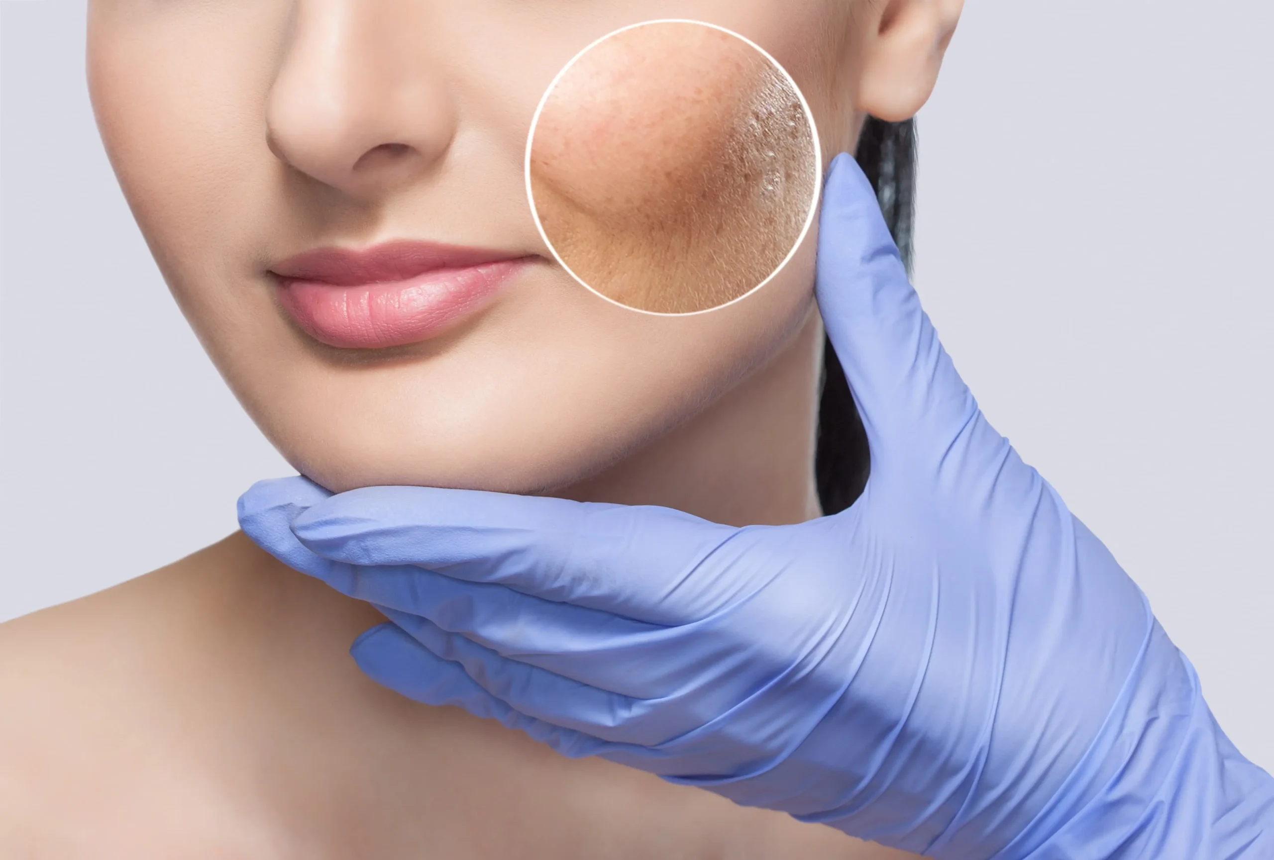 Acne Treatment by Daily Glow Aesthetic (no s) and Bio-Age Medicine in San Diego, CA