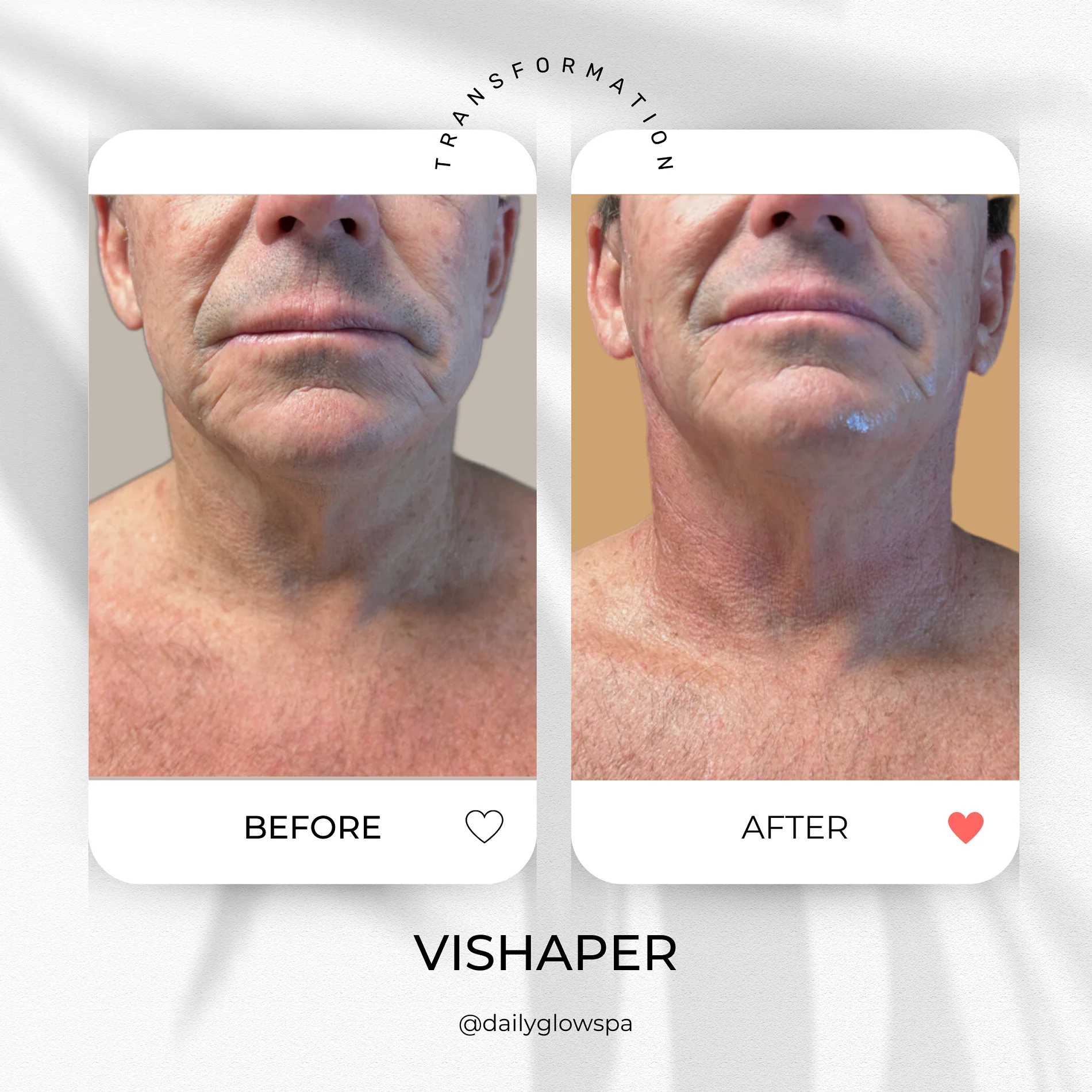 Dailyglowspa_Before_and_After_Body_Contouring_One_in_San_Diego_CA