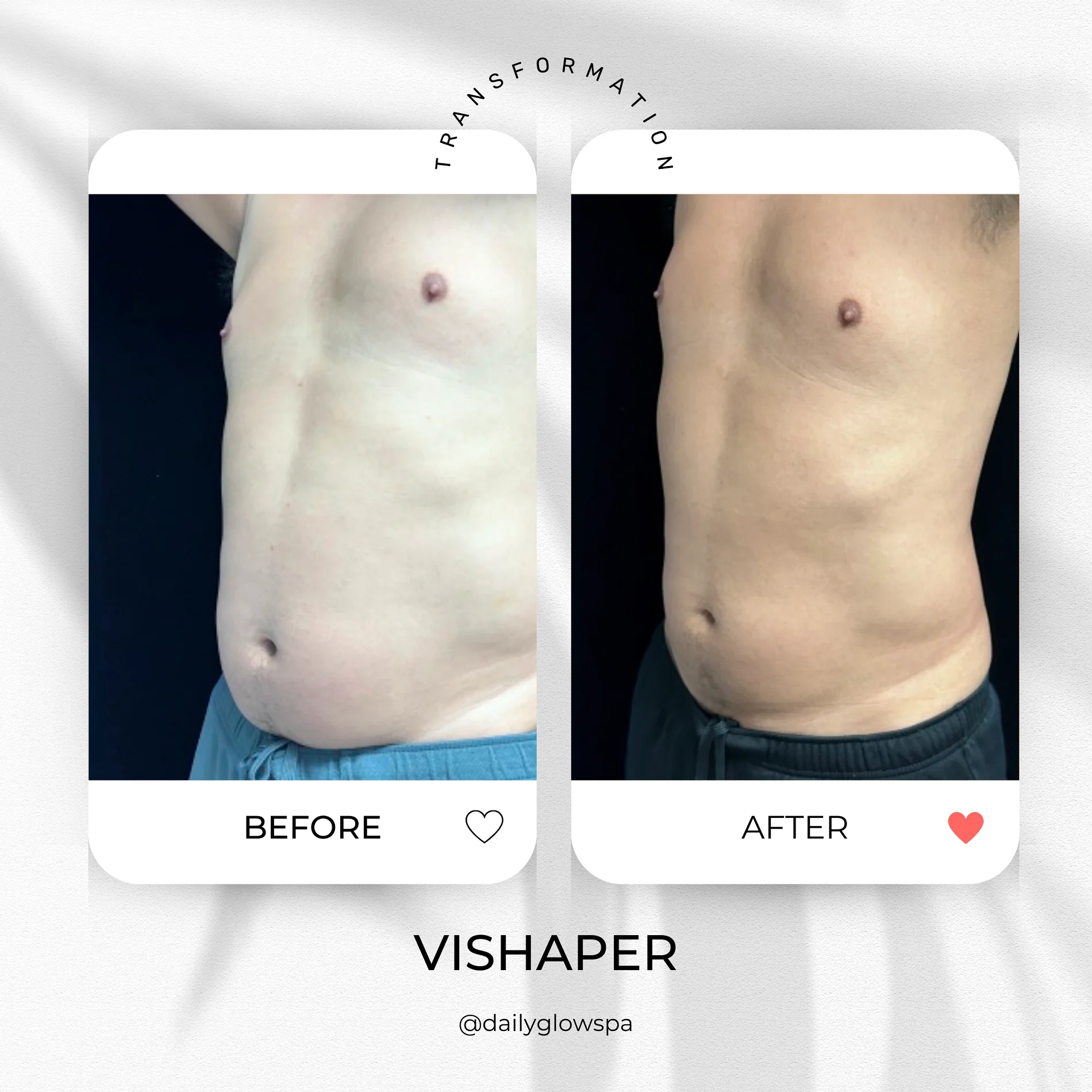 Dailyglowspa_Before_and_After_Body_Contouring_Three_in_San_Diego_CA