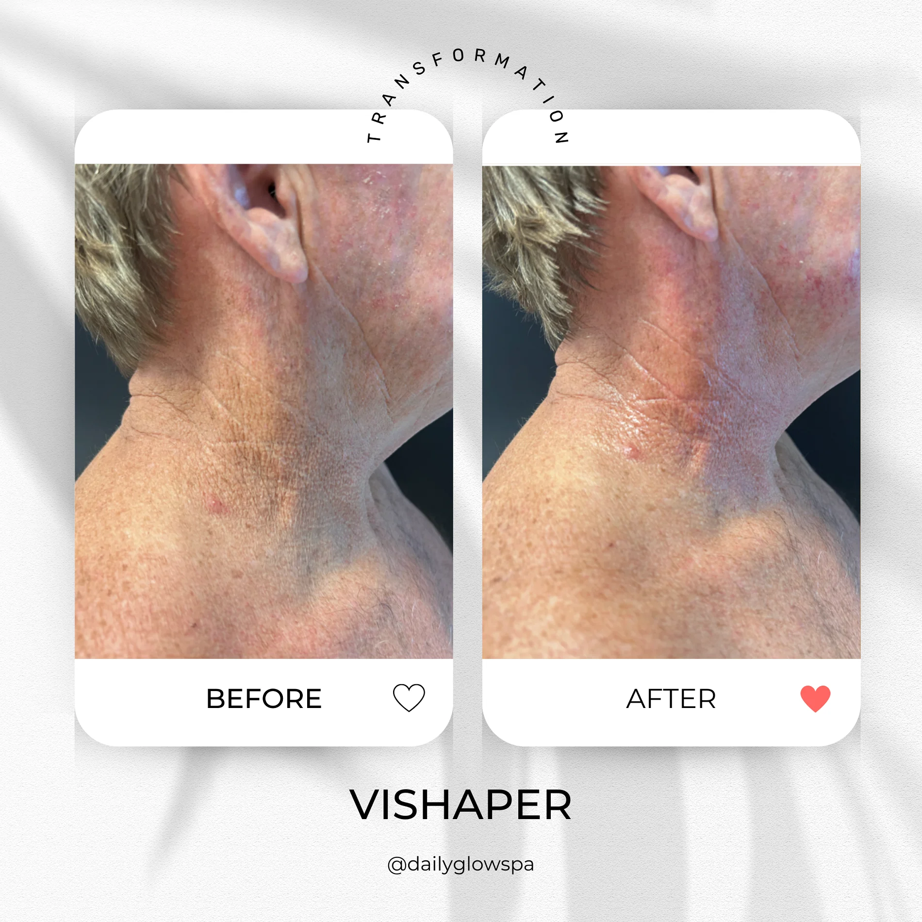 Dailyglowspa_Before_and_After_Body_Contouring_Two_in_San_Diego_CA