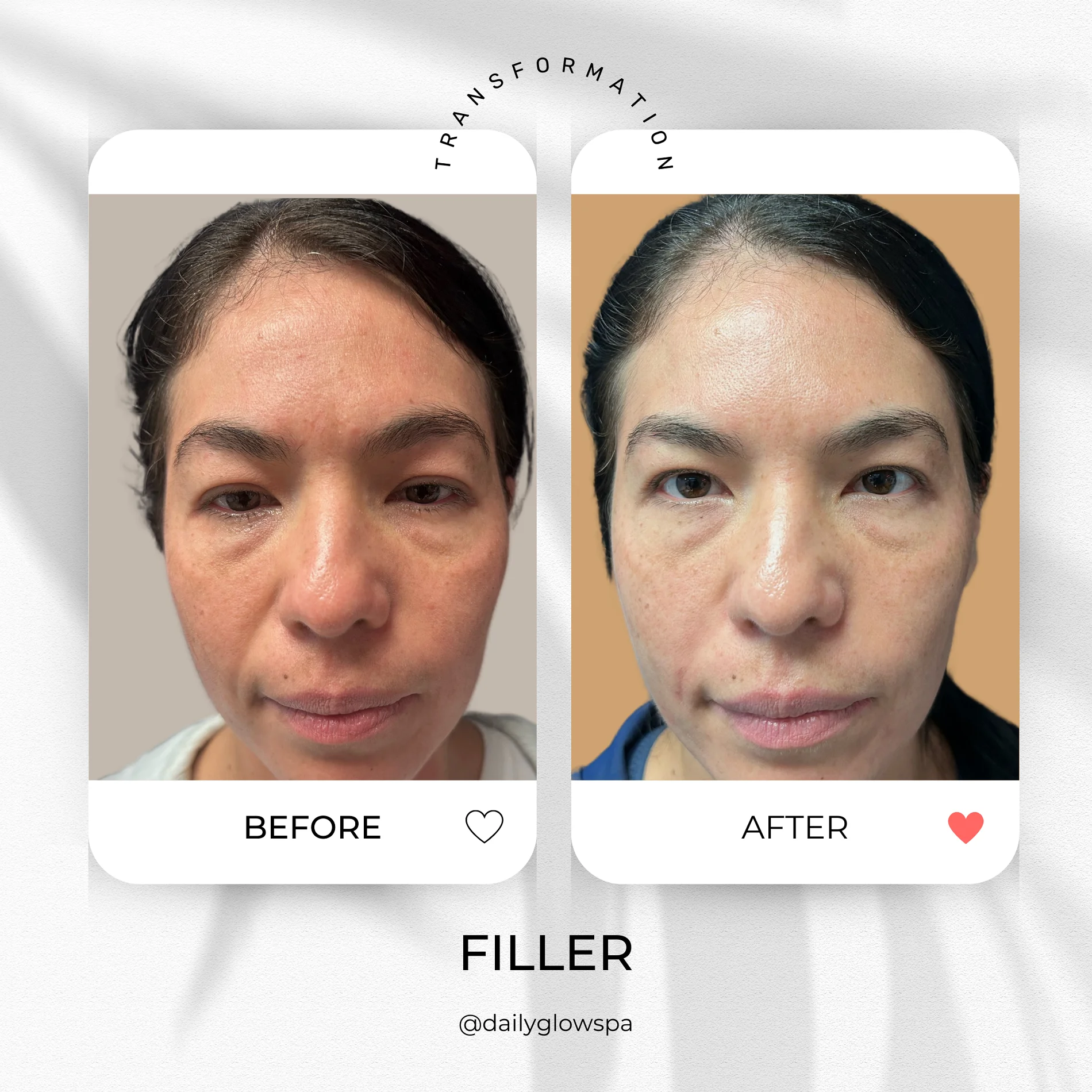Dailyglowspa_Before_and_After_Dermal_Fillers_Five_in_San_Diego_CA