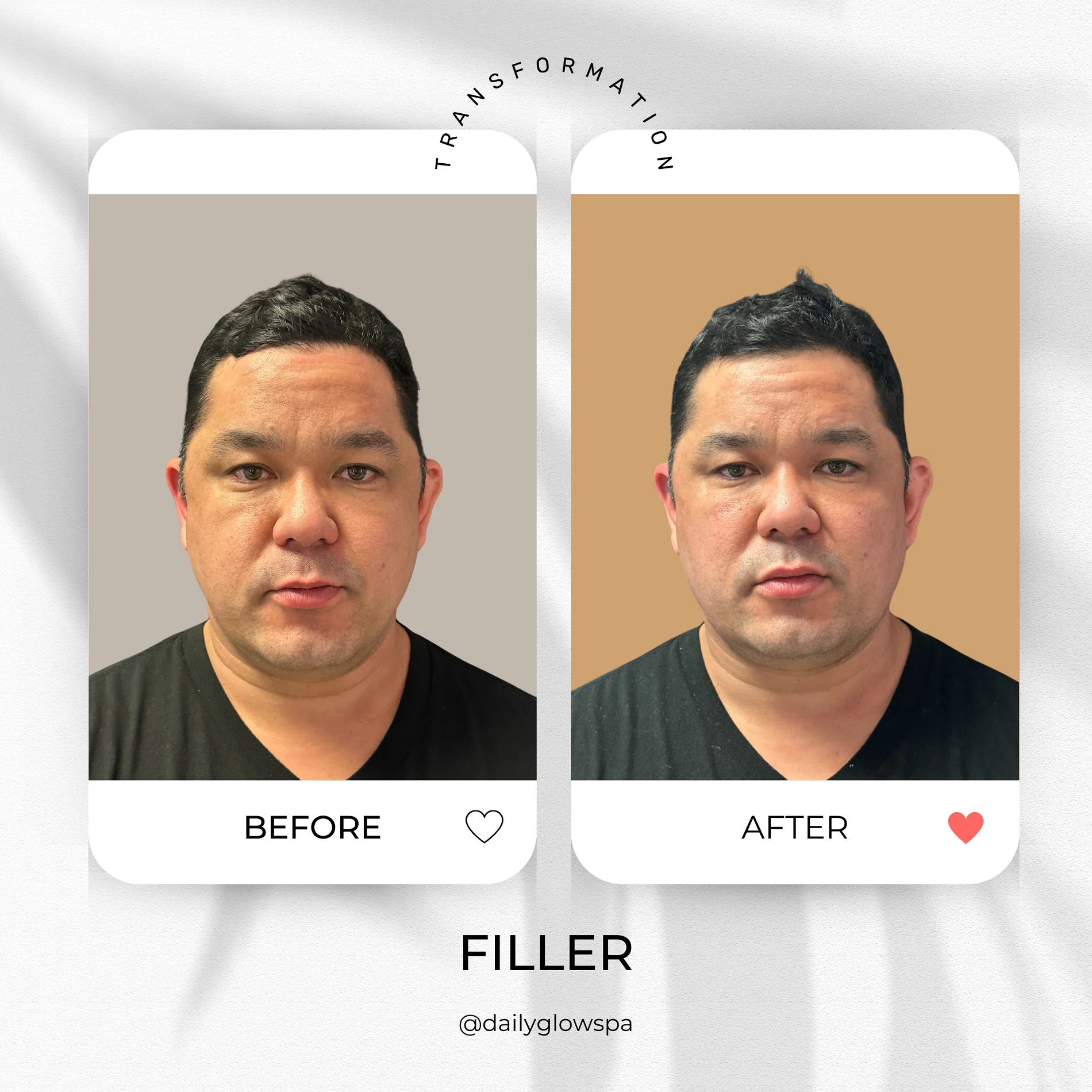 Dailyglowspa_Before_and_After_Dermal_Fillers_Four_in_San_Diego_CA
