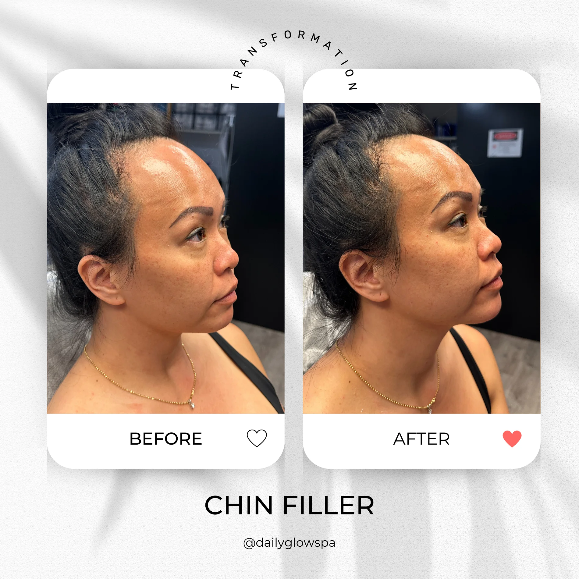 Dailyglowspa_Before_and_After_Dermal_Fillers_One_in_San_Diego_CA