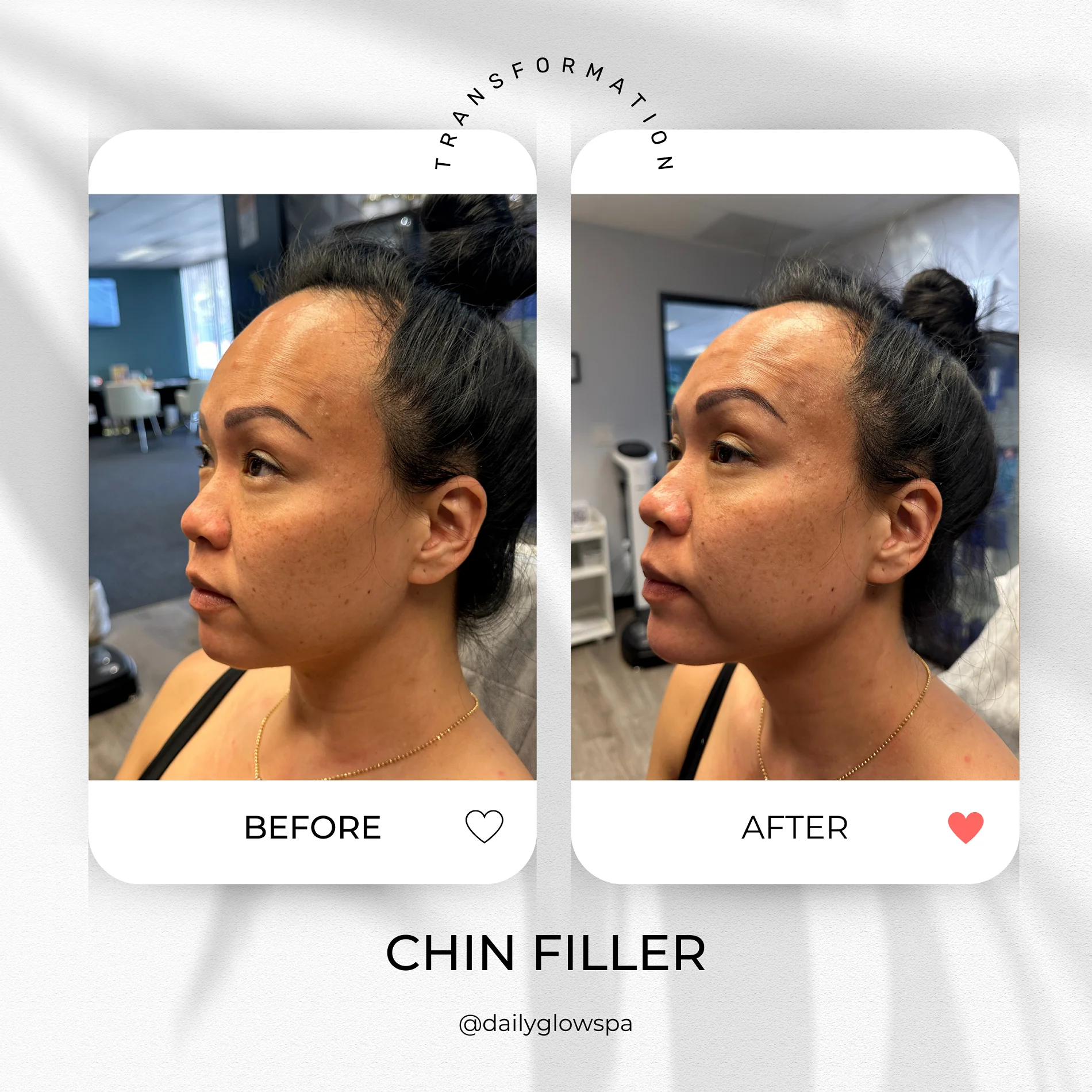 Dailyglowspa_Before_and_After_Dermal_Fillers_Two_in_San_Diego_CA