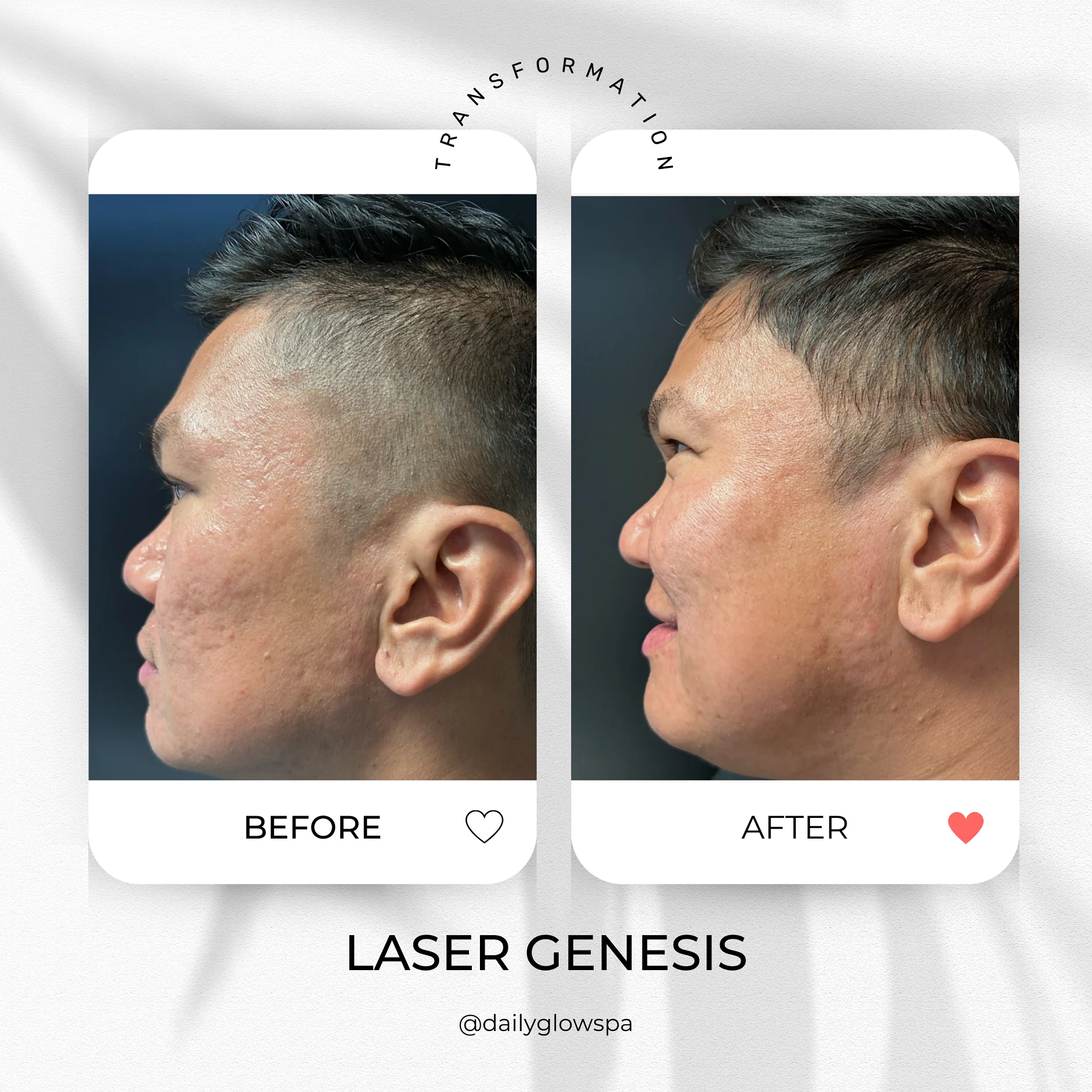 Dailyglowspa_Before_and_After_LASER_TREATMENTS_WITH_CUTERA_Five_in_San_Diego_CA