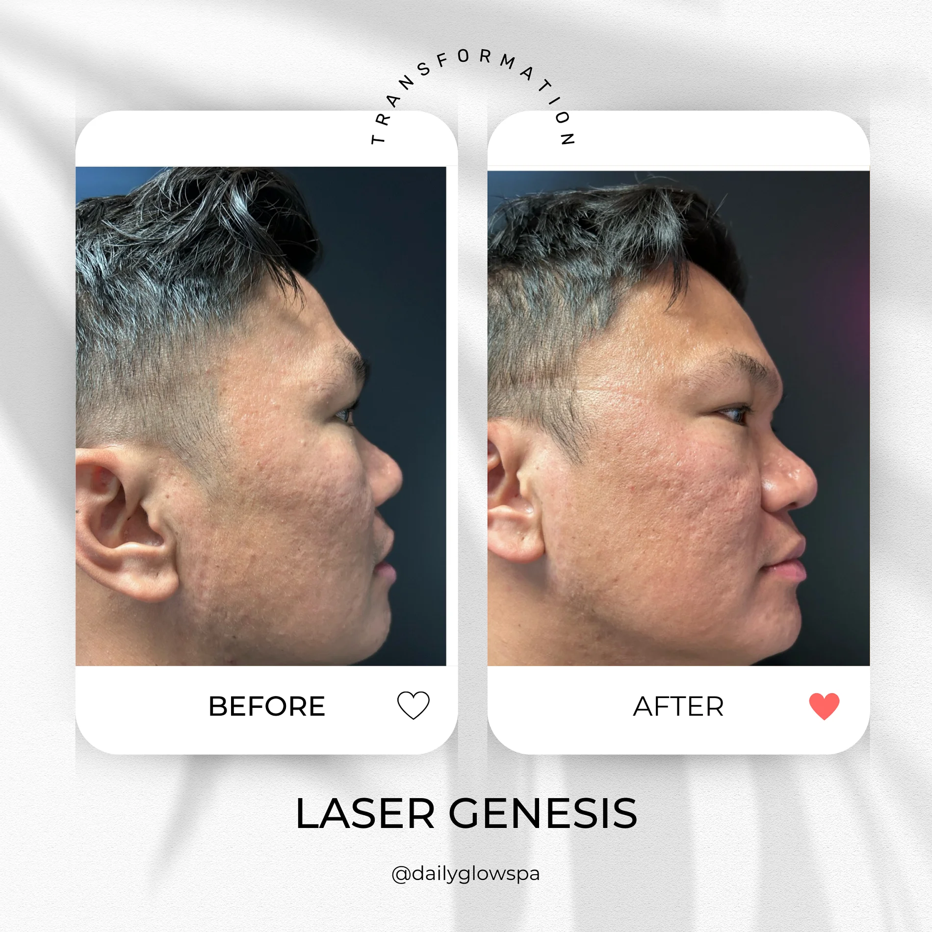 Dailyglowspa_Before_and_After_LASER_TREATMENTS_WITH_CUTERA_Four_in_San_Diego_CA