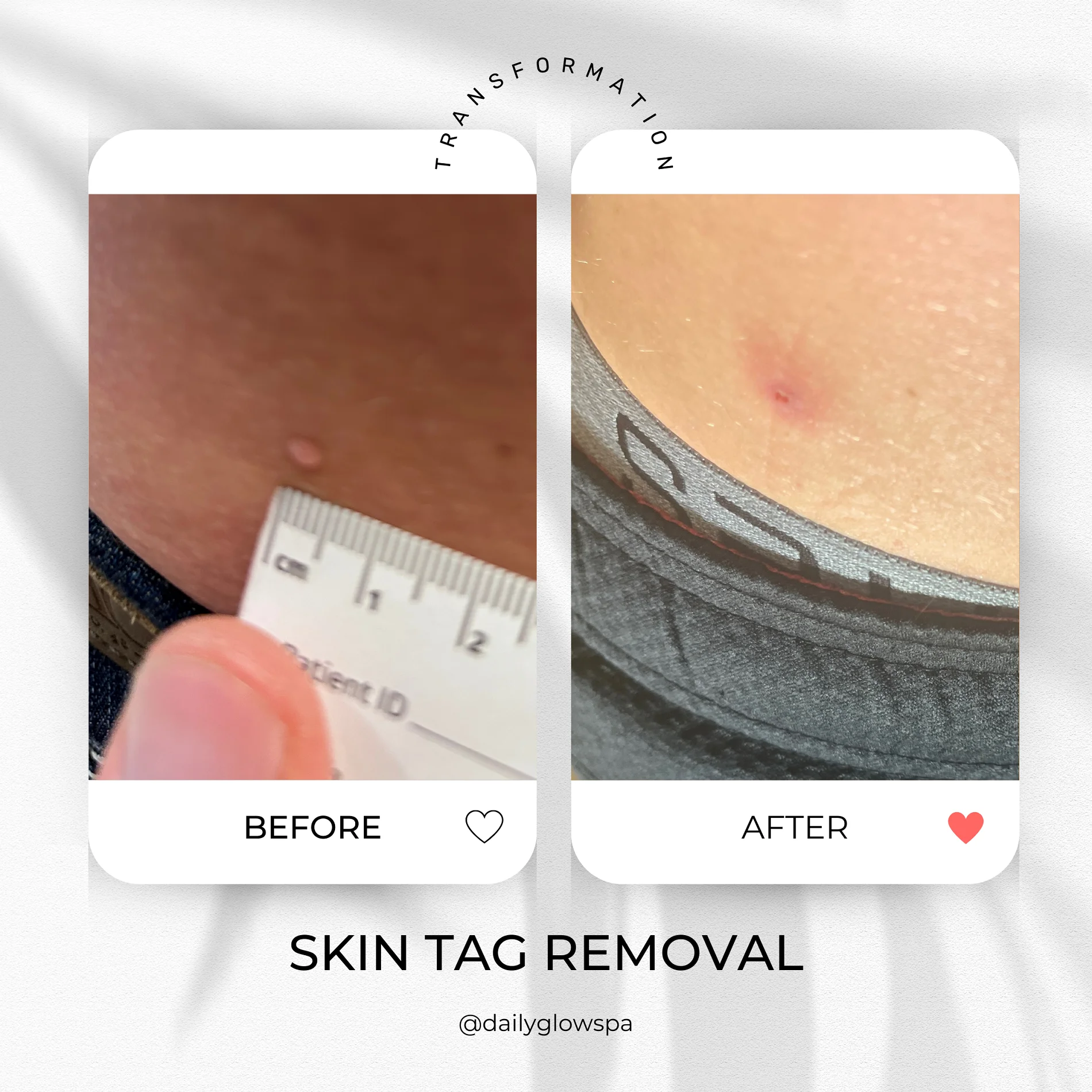 Dailyglowspa_Before_and_After_LASER_TREATMENTS_WITH_CUTERA_One_in_San_Diego_CA