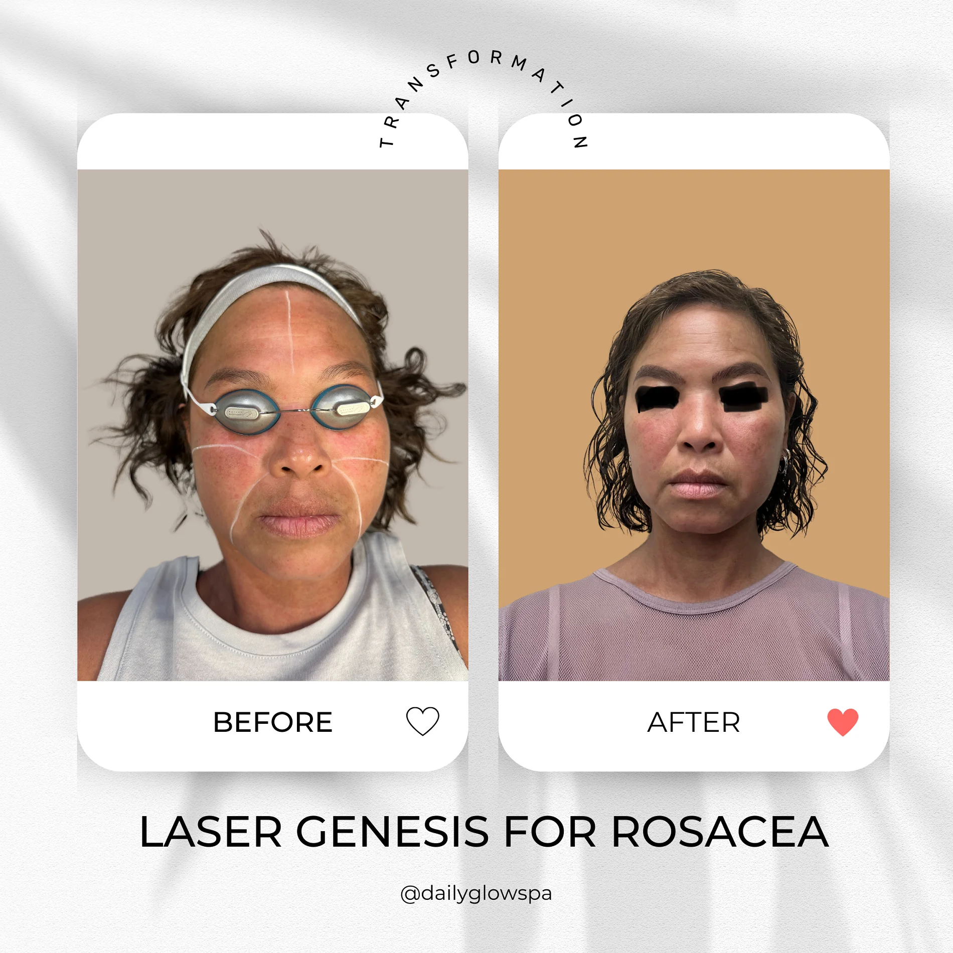 Dailyglowspa_Before_and_After_LASER_TREATMENTS_WITH_CUTERA_Three_in_San_Diego_CA