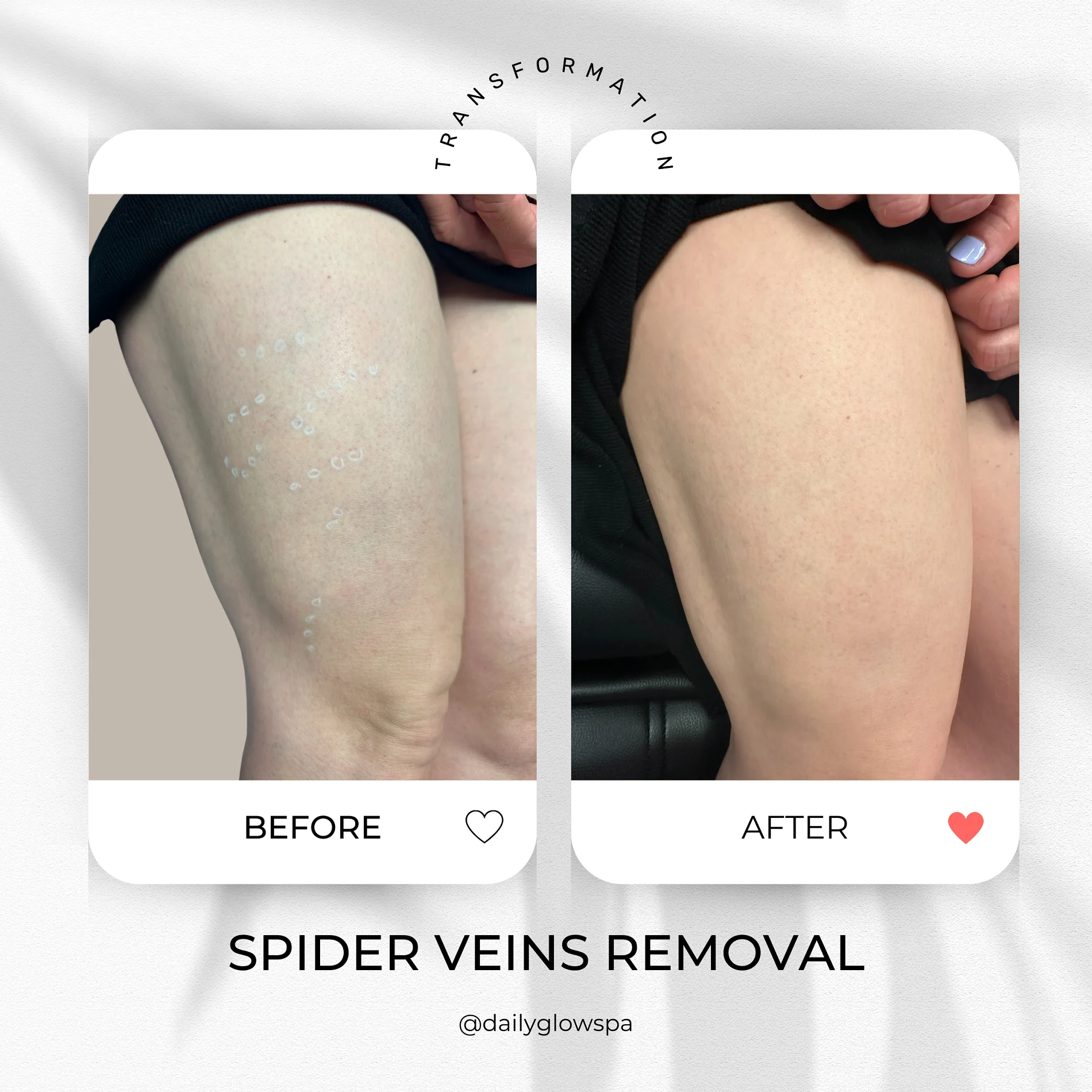 Dailyglowspa_Before_and_After_LASER_TREATMENTS_WITH_CUTERA_Two_in_San_Diego_CA