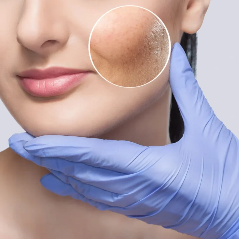 Acne-Treatment-by-Daily-Glow-Aesthetic-no-s-and-Bio-Age-Medicine-in-San-Diego-CA-min-2048x1383