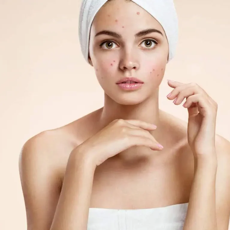 AviClear-Acne-Treatment-by-Daily-Glow-Spa-in-San-Diego-CA